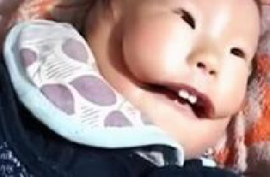 孩子出生就自带面具，脸部严重畸形，医生直言从医30年从未见过