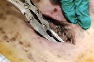 一个视频让你直观地了解什么叫坏死性“筋膜”炎