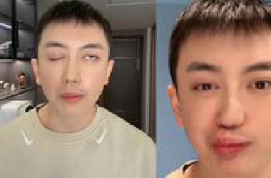 网红金大威整容失败，帅气小鲜肉变成丑八怪，脸部肌肉损坏成面瘫