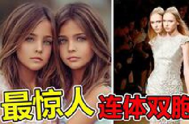 世界上“最罕见”的10对，连体双胞胎