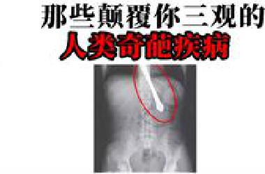 阴茎永久充血、巨*症...颠覆你三观的奇葩疾病！